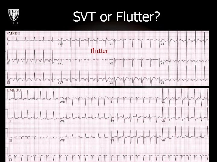 ICU SVT or Flutter? flutter 