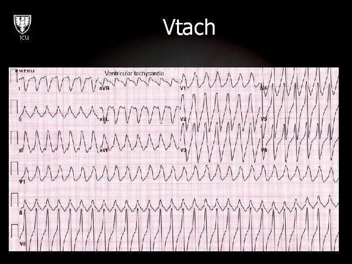 ICU Vtach 