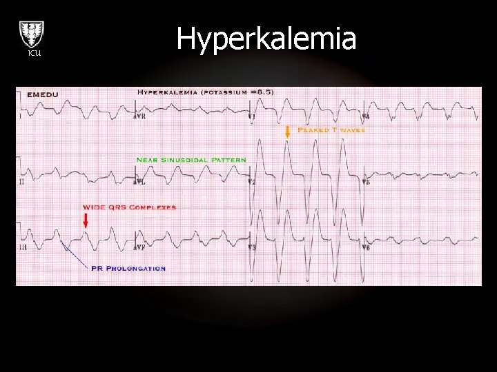 ICU Hyperkalemia 