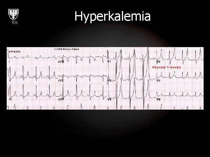 ICU Hyperkalemia 