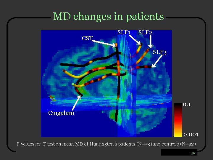 MD changes in patients CST SLF 1 SLF 2 SLF 3 0. 1 Cingulum