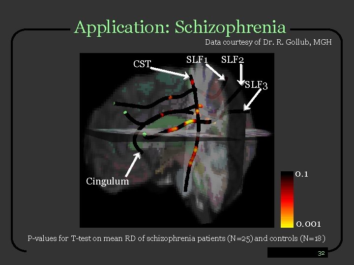 Application: Schizophrenia Data courtesy of Dr. R. Gollub, MGH CST SLF 1 SLF 2