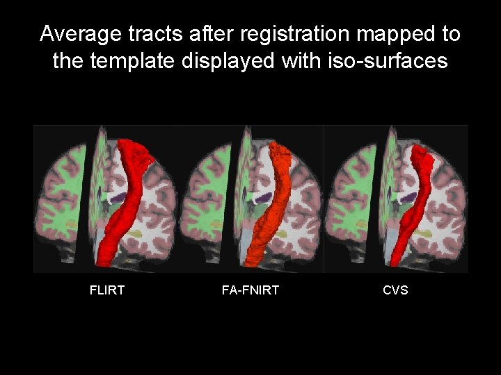 Average tracts after registration mapped to the template displayed with iso-surfaces FLIRT FA-FNIRT CVS