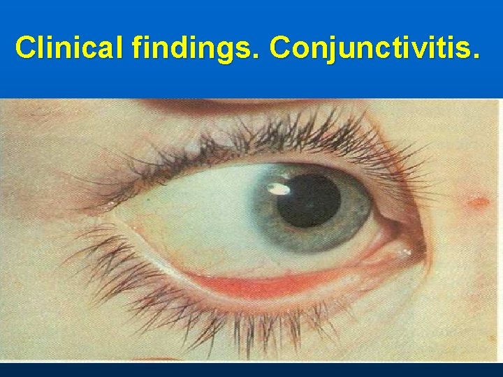 Clinical findings. Conjunctivitis. 