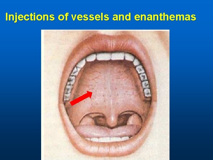 Injections of vessels and enanthemas 