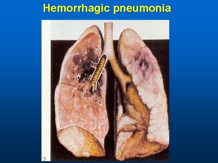 Hemorrhagic pneumonia 
