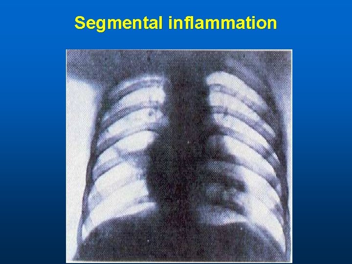 Segmental inflammation 