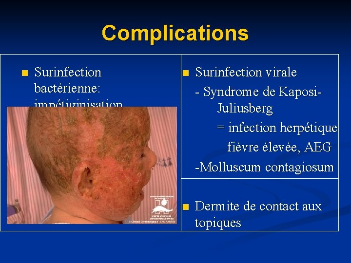 Complications n Surinfection bactérienne: impétiginisation n Surinfection virale - Syndrome de Kaposi. Juliusberg = Complications n Surinfection bactérienne: impétiginisation n Surinfection virale - Syndrome de Kaposi. Juliusberg =