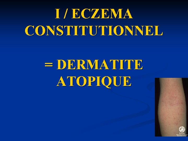 I / ECZEMA CONSTITUTIONNEL = DERMATITE ATOPIQUE I / ECZEMA CONSTITUTIONNEL = DERMATITE ATOPIQUE