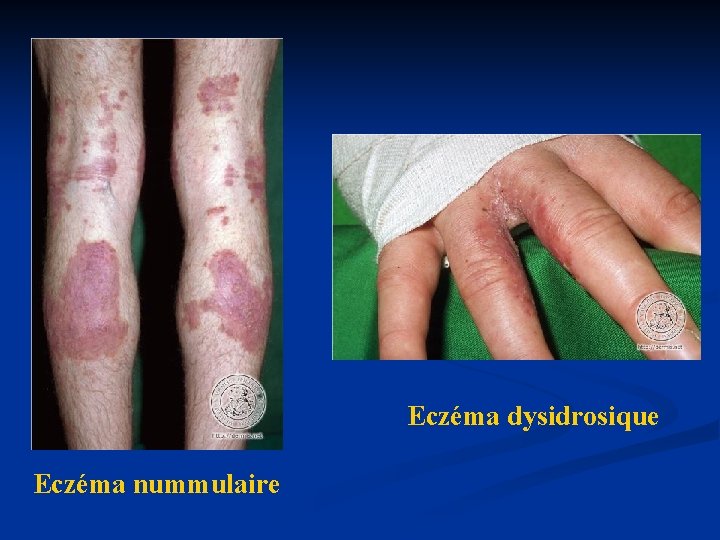 Eczéma dysidrosique Eczéma nummulaire Eczéma dysidrosique Eczéma nummulaire