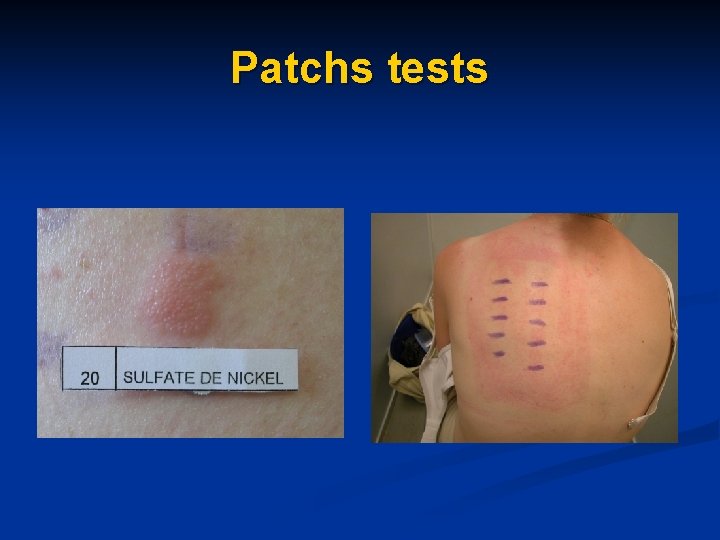 Patchs tests Patchs tests
