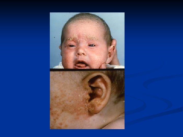 Eczema Constitutionnel Et De Contact I Eczema Constitutionnel