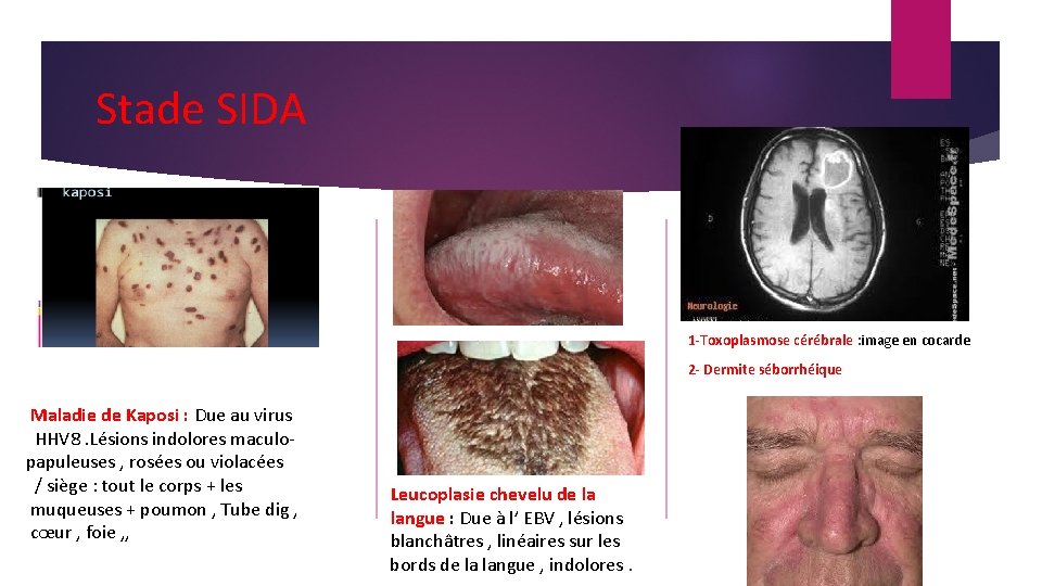 Stade SIDA 1 -Toxoplasmose cérébrale : image en cocarde 2 - Dermite séborrhéique Maladie