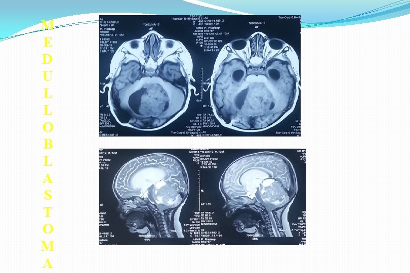 M E D U L L O B L A S T O M