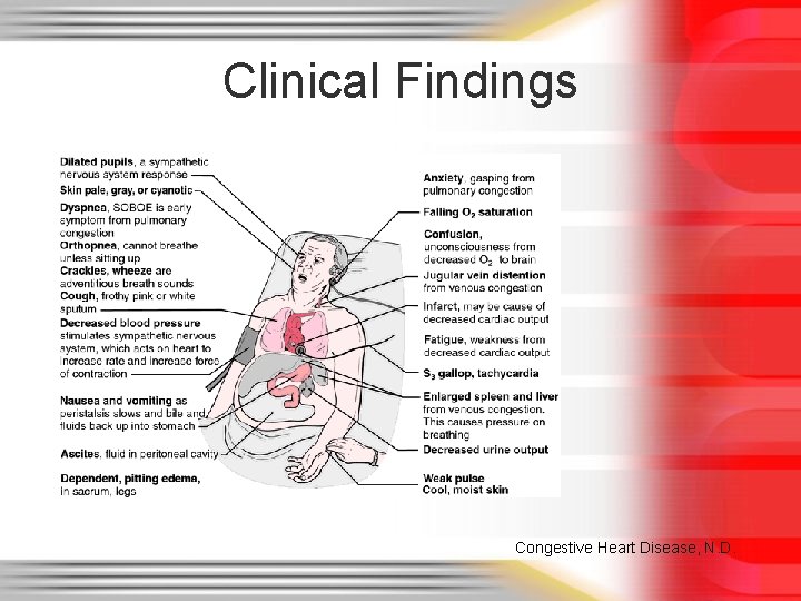 Clinical Findings Congestive Heart Disease, N. D. 