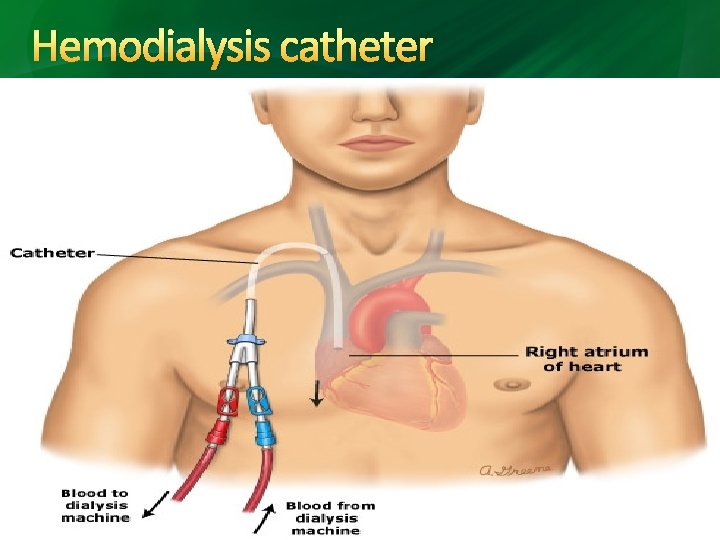 Hemodialysis catheter 