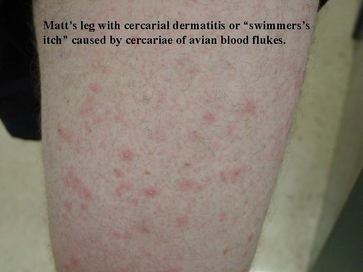 Matt’s leg with cercarial dermatitis or “swimmers’s itch” caused by cercariae of avian blood