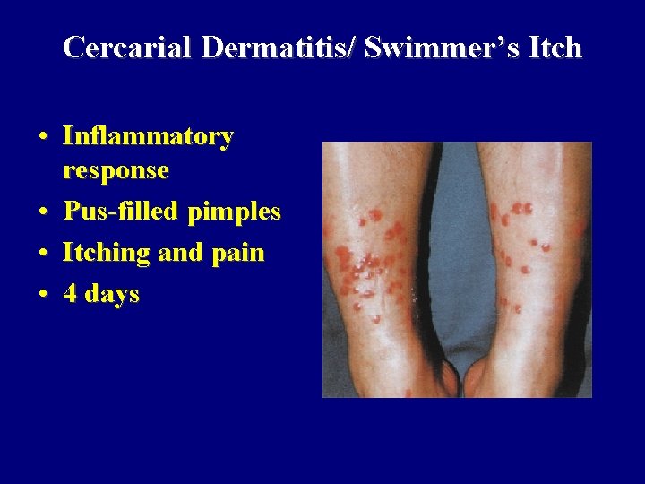 Cercarial Dermatitis/ Swimmer’s Itch • Inflammatory response • Pus-filled pimples • Itching and pain