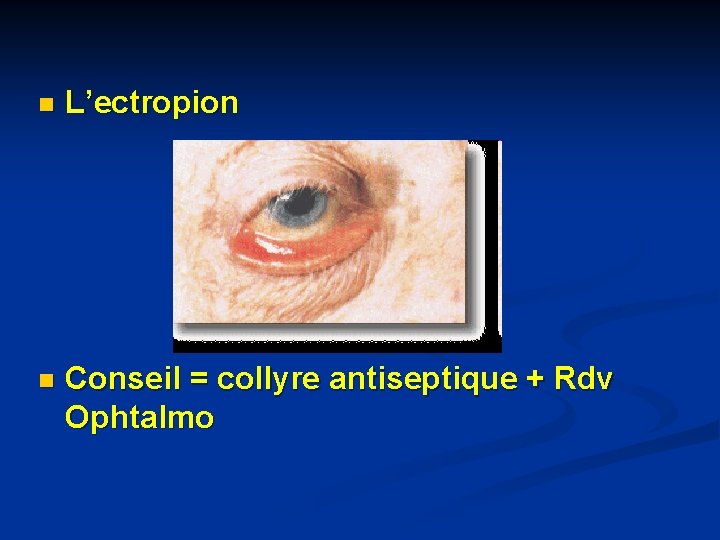 n L’ectropion n Conseil = collyre antiseptique + Rdv Ophtalmo n L’ectropion n Conseil = collyre antiseptique + Rdv Ophtalmo