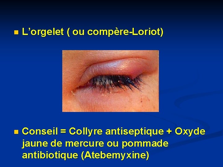 n L’orgelet ( ou compère-Loriot) n Conseil = Collyre antiseptique + Oxyde jaune de n L’orgelet ( ou compère-Loriot) n Conseil = Collyre antiseptique + Oxyde jaune de