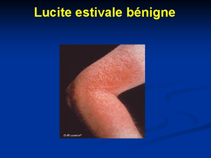 Lucite estivale bénigne Lucite estivale bénigne