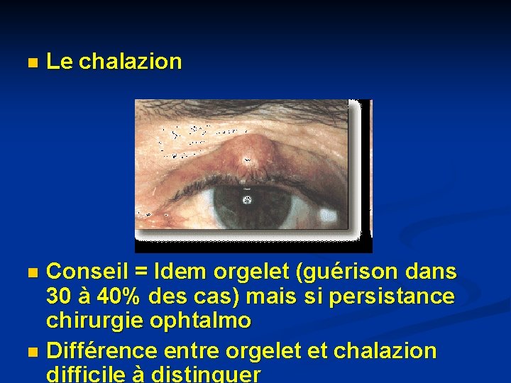 n Le chalazion Conseil = Idem orgelet (guérison dans 30 à 40% des cas) n Le chalazion Conseil = Idem orgelet (guérison dans 30 à 40% des cas)