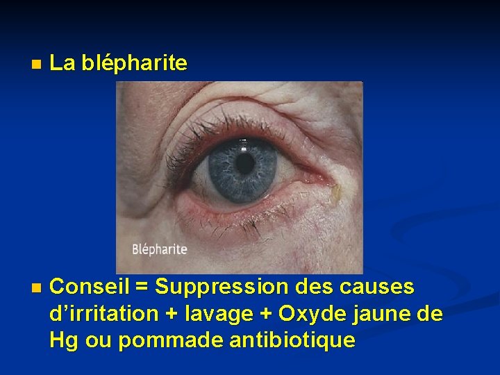 n La blépharite n Conseil = Suppression des causes d’irritation + lavage + Oxyde n La blépharite n Conseil = Suppression des causes d’irritation + lavage + Oxyde