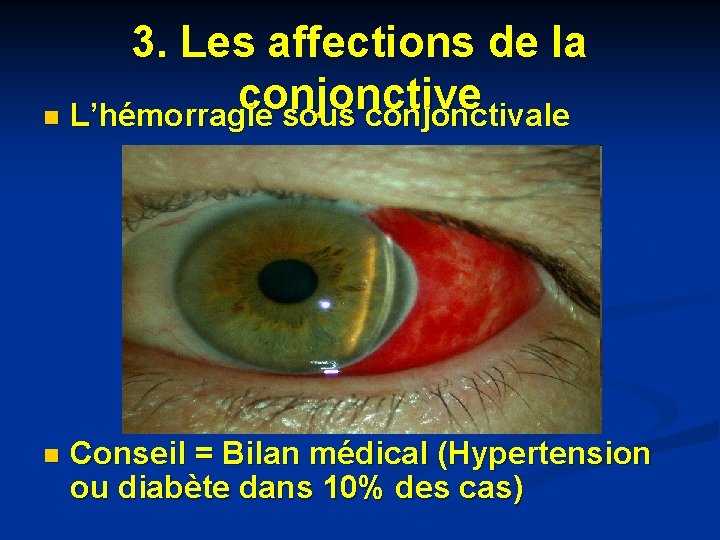 3. Les affections de la conjonctive n L’hémorragie sous conjonctivale n Conseil = Bilan 3. Les affections de la conjonctive n L’hémorragie sous conjonctivale n Conseil = Bilan