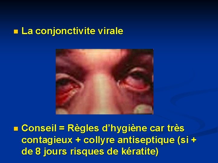 n La conjonctivite virale n Conseil = Règles d’hygiène car très contagieux + collyre n La conjonctivite virale n Conseil = Règles d’hygiène car très contagieux + collyre
