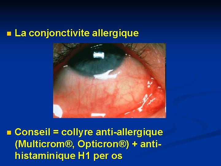n La conjonctivite allergique n Conseil = collyre anti-allergique (Multicrom®, Opticron®) + antihistaminique H n La conjonctivite allergique n Conseil = collyre anti-allergique (Multicrom®, Opticron®) + antihistaminique H