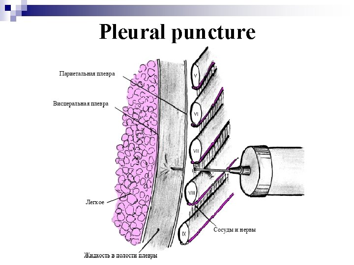 Pleural puncture 