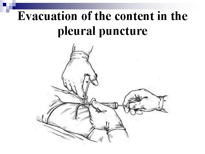 Evacuation of the content in the pleural puncture 