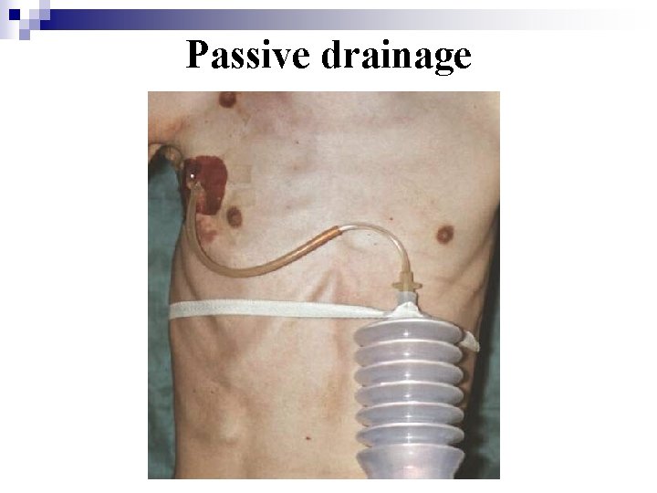 Passive drainage 