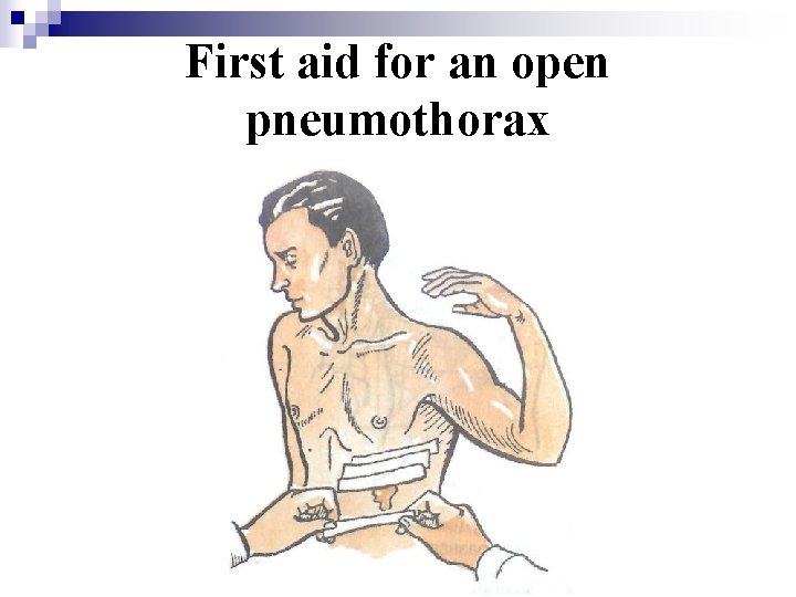 First aid for an open pneumothorax 