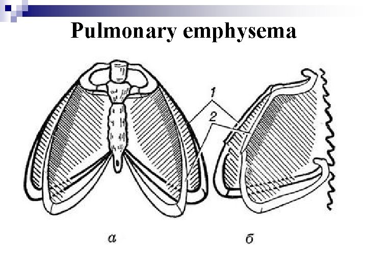 Pulmonary emphysema 