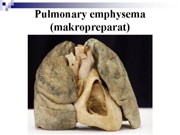 Pulmonary emphysema (makropreparat) 
