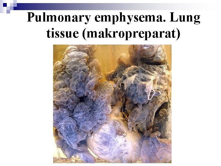 Pulmonary emphysema. Lung tissue (makropreparat) 