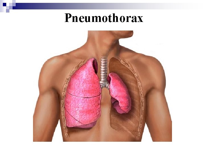 Pneumothorax 