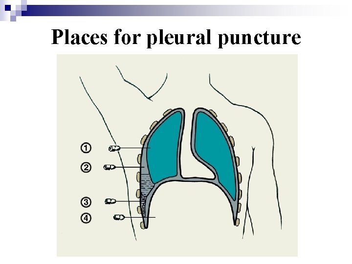 Places for pleural puncture 
