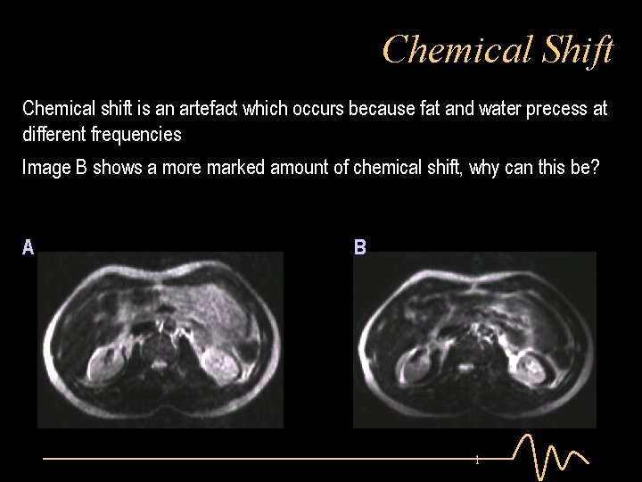 Chemical Shift Chemical shift is an artefact which occurs because fat and water precess