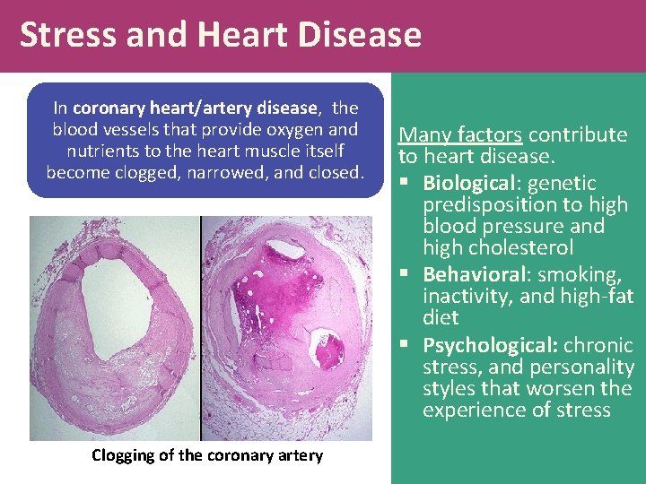 Stress and Heart Disease In coronary heart/artery disease, the blood vessels that provide oxygen