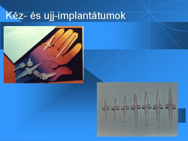 Kéz- és ujj-implantátumok 