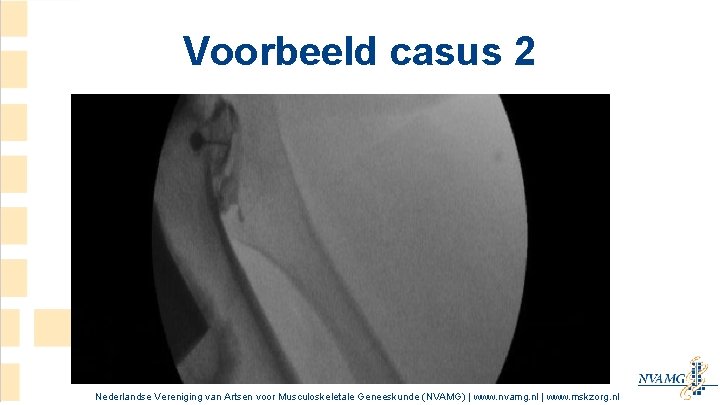 Voorbeeld casus 2 Nederlandse Vereniging van Artsen voor Musculoskeletale Geneeskunde (NVAMG) | www. nvamg. Voorbeeld casus 2 Nederlandse Vereniging van Artsen voor Musculoskeletale Geneeskunde (NVAMG) | www. nvamg.