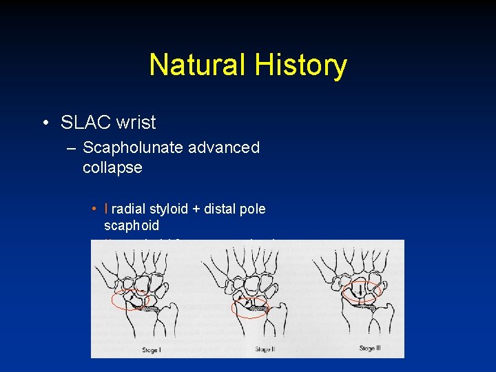 Natural History • SLAC wrist – Scapholunate advanced collapse • I radial styloid +