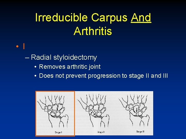 Irreducible Carpus And Arthritis • I – Radial styloidectomy • Removes arthritic joint •