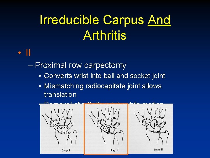 Irreducible Carpus And Arthritis • II – Proximal row carpectomy • Converts wrist into