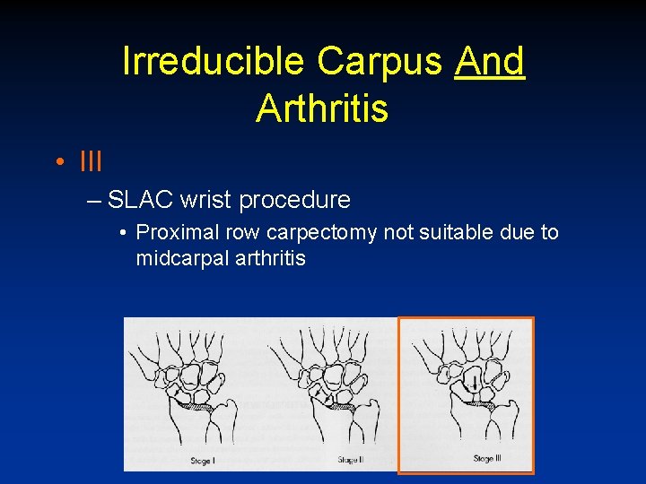 Irreducible Carpus And Arthritis • III – SLAC wrist procedure • Proximal row carpectomy