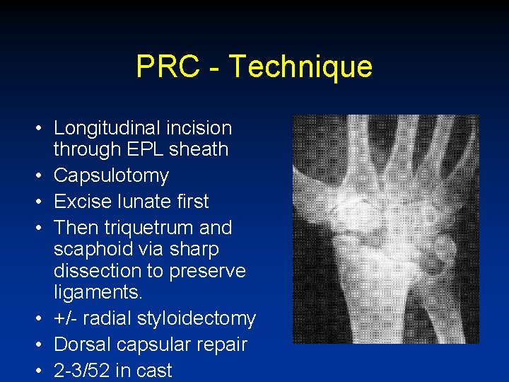 PRC - Technique • Longitudinal incision through EPL sheath • Capsulotomy • Excise lunate