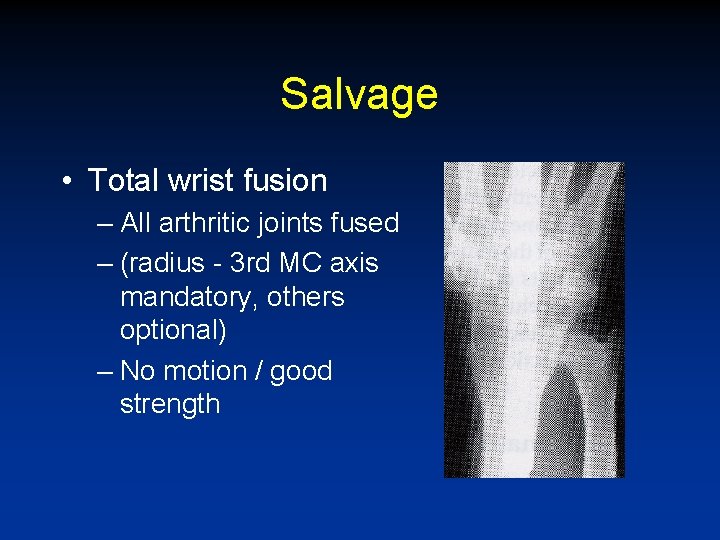 Salvage • Total wrist fusion – All arthritic joints fused – (radius - 3