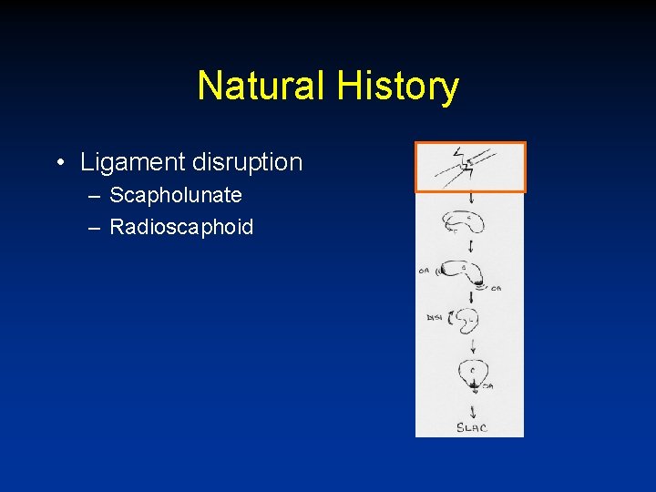 Natural History • Ligament disruption – Scapholunate – Radioscaphoid 